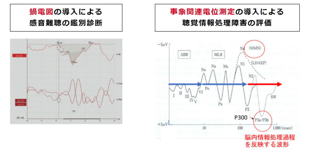 蝸電図の導入による感音難聴の鑑別診断と事象関連電位測位の導入による聴覚情報処理障害の評価