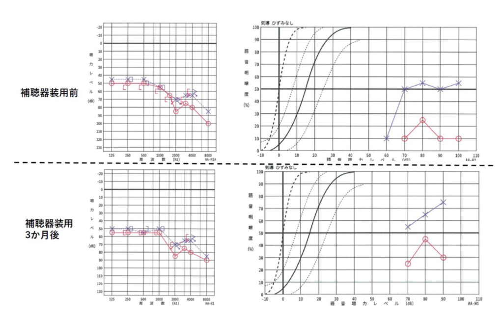 補聴器装用によって、補聴器非装用時の語音明瞭度が改善した例